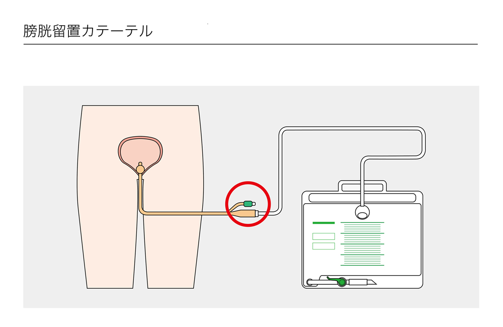 採尿バッグ 交換 セール