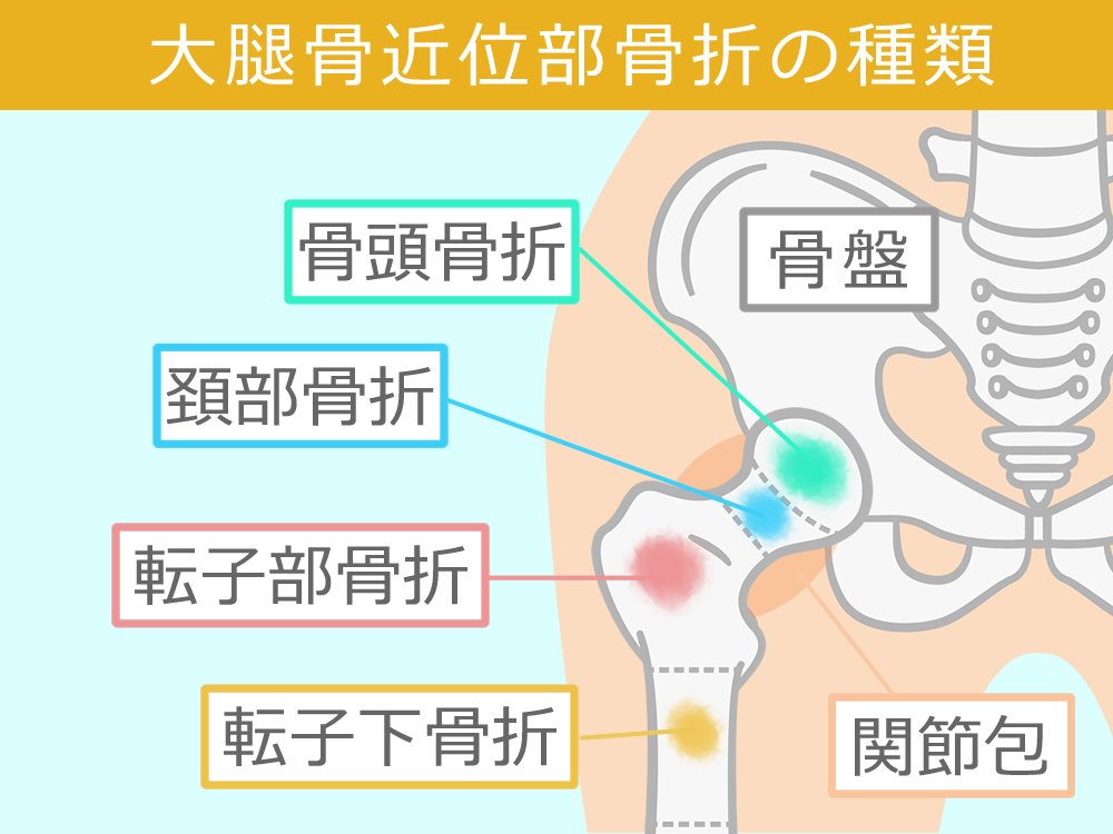 高齢者の大腿近位部部骨折における訪問看護に求められる視点と